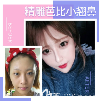 贵州利美康隆鼻好不好