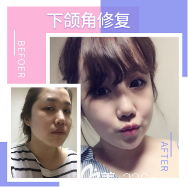 <!--<i data=20240703-sp></i>-->下颌角整形案例