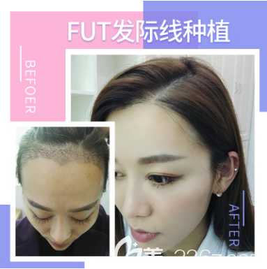 <!--<i data=20240703-sp></i>-->发际线种植案例