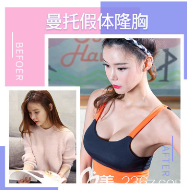 <!--<i data=20240703-sp></i>-->曼托假体丰胸案例