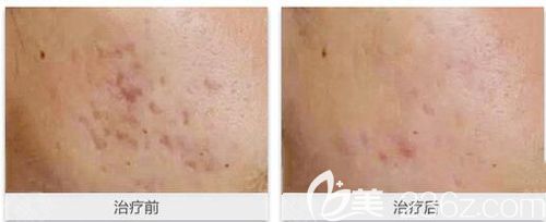 在十堰安琪儿激光嫩肤祛痘真人案例效果 在十堰安琪儿激光嫩肤祛痘真人案例效果