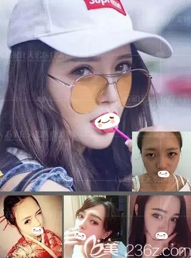 天宏整形做双眼皮手术案例 天宏整形做双眼皮手术案例