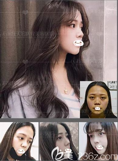 石家庄天宏做鼻综合整形案例 石家庄天宏做鼻综合整形案例