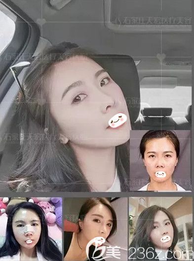 天宏整形医院做鼻综合和自体脂肪填充面部案例 天宏整形医院做鼻综合和自体脂肪填充面部案例