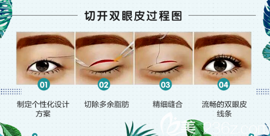 广州美莱刘志坤医生双眼皮过程图