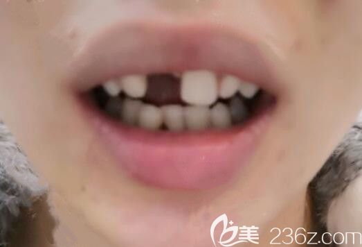 上海恒愿齿科郑奎院长给我做即刻种牙过程