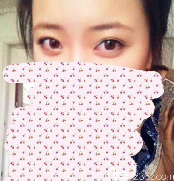 韩国MVP整形外科做双眼皮怎么样 韩国MVP整形外科做双眼皮怎么样