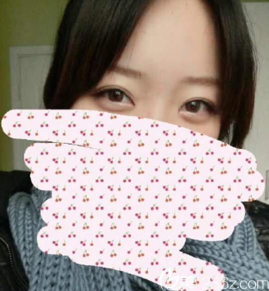 在韩国MVP整形外科玄炅倍做的开眼角价格1万2，不得不承认是美了感觉鼻梁变挺了