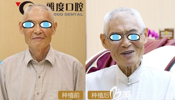 70岁老人选择德国4D微创全口种植牙前后对比效果