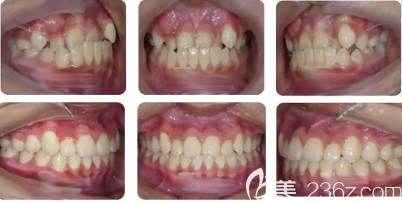 青少年地包天矫正案例效果 青少年地包天矫正案例效果