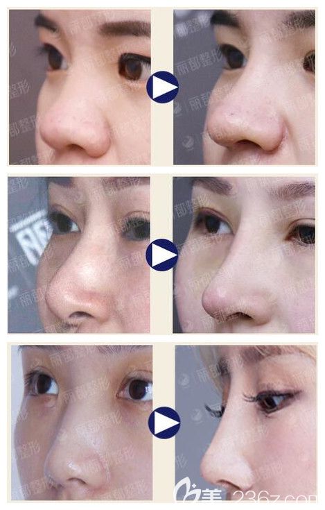 无锡丽都隆鼻案例对比 无锡丽都隆鼻案例对比
