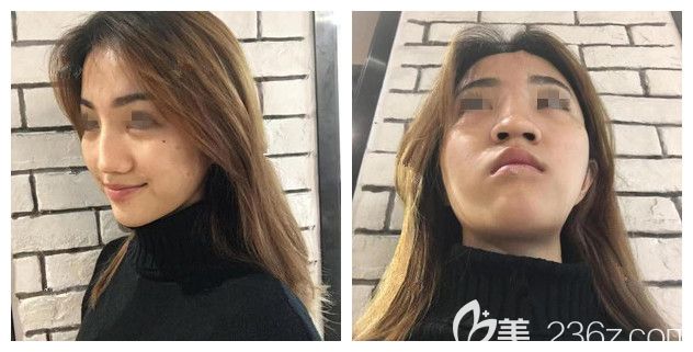 面诊无锡丽都术前鼻梁有些歪,整体的鼻子塌塌的 面诊无锡丽都术前鼻梁有些歪,整体的鼻子塌塌的