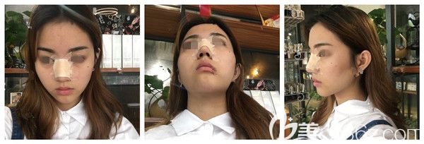 刚做完鼻综合术后效果图 刚做完鼻综合术后效果图