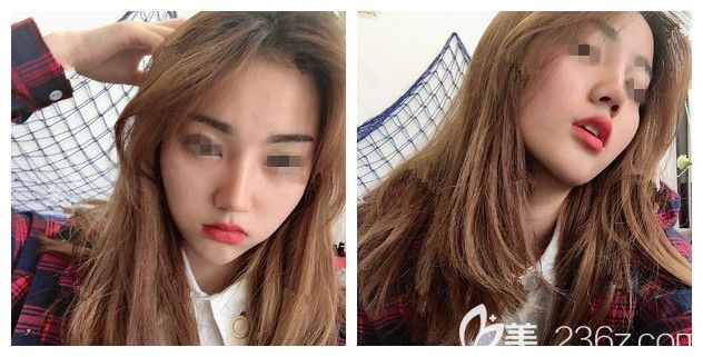 拆线后硅胶假体隆鼻+耳软骨垫鼻尖恢复 拆线后硅胶假体隆鼻+耳软骨垫鼻尖恢复