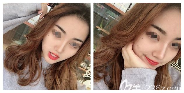 做硅胶假体隆鼻+耳软骨垫鼻尖术后20天恢复 做硅胶假体隆鼻+耳软骨垫鼻尖术后20天恢复