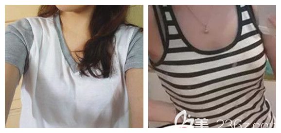 我在南宁韩星整形做隆胸手术前的照片 我在南宁韩星整形做隆胸手术前的照片