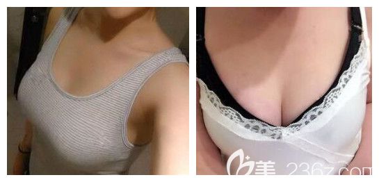 南宁正规丰胸医院是哪家?本人在南宁韩星整形做自体脂肪隆胸,恢复30天效果是这样的...