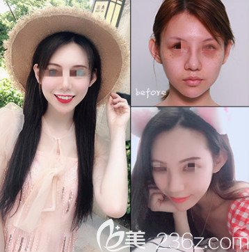 在烟台做的激光祛斑的手术，不贵也就几千块而已但是效果真的让我很惊讶