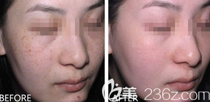 德州天宏做激光祛斑手术做的蛮干净的，来看我的恢复日记吧