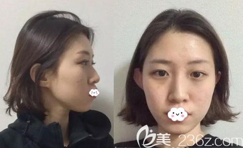 韩国欧米茄整形医院生机脂肪移植+鼻综合隆鼻真人案例 韩国欧米茄整形医院生机脂肪移植+鼻综合隆鼻真人案例