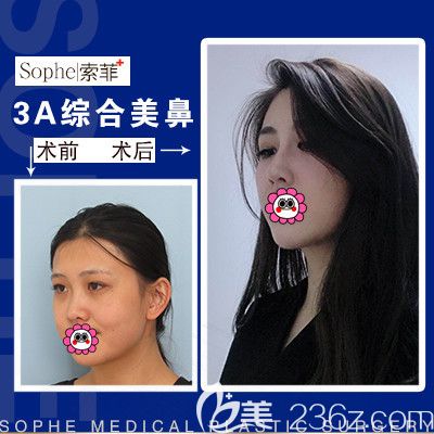 哈尔滨索菲陈富全鼻综合整形 哈尔滨索菲陈富全鼻综合整形