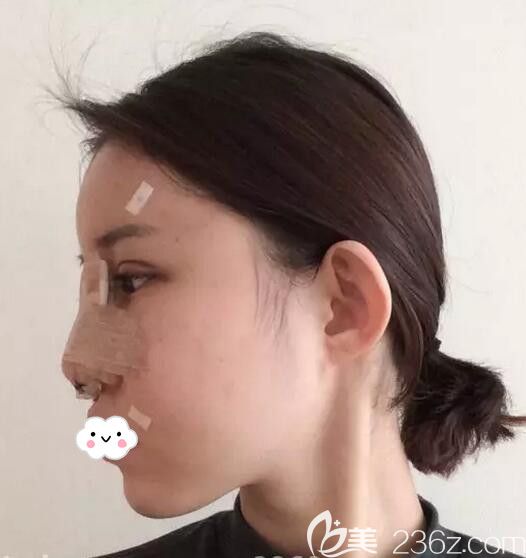 韩国欧米茄整形医院生机脂肪移植填充全脸+鼻综合案例术后第3天恢复图 韩国欧米茄整形医院生机脂肪移植填充全脸+鼻综合案例术后第3天恢复图