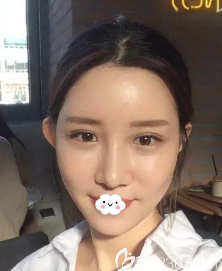 韩国欧米茄整形自体脂肪面部填充+假体隆鼻术后20天 韩国欧米茄整形自体脂肪面部填充+假体隆鼻术后20天