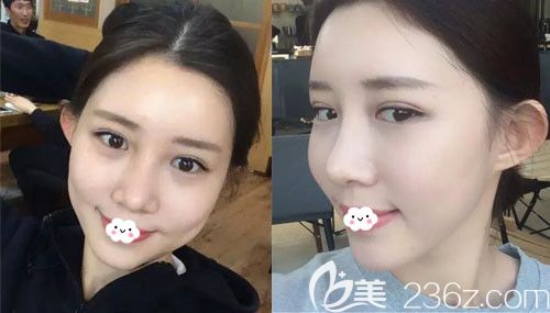 自体脂肪面部填充恢复期是多久？韩国欧米茄整形医院生机脂肪移植+鼻综合案例图见证