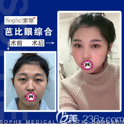 哈尔滨索菲刘刚芭比眼综合效果 哈尔滨索菲刘刚芭比眼综合效果
