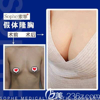 哈尔滨索菲陈富全隆胸效果对比 哈尔滨索菲陈富全隆胸效果对比