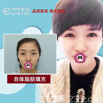 哈尔滨索菲吕松岩面部脂肪填充案例 哈尔滨索菲吕松岩面部脂肪填充案例