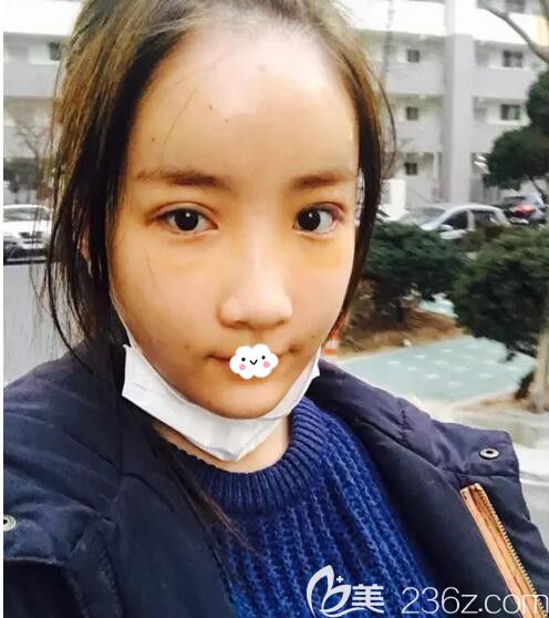 韩国欧米茄晶透下眼皮整形去眼袋+黑眼圈后拥有卧蚕