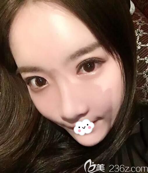 韩国去眼袋+去黑眼圈术后20天恢复效果图