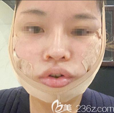 在韩国迪美丽做面部提升+吸脂去双下巴手术当天