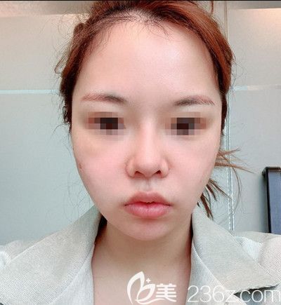 在韩国迪美丽做面部提升+吸脂去双下巴术后1天