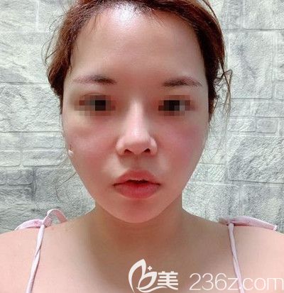 在韩国迪美丽做面部提升+吸脂去双下巴术后2天