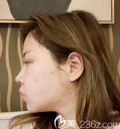 在韩国迪美丽做面部提升+吸脂去双下巴术后7天 在韩国迪美丽做面部提升+吸脂去双下巴术后7天