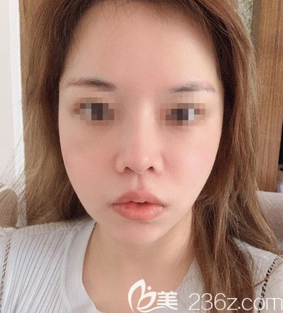 在韩国迪美丽做面部提升+吸脂去双下巴术后14天 在韩国迪美丽做面部提升+吸脂去双下巴术后14天