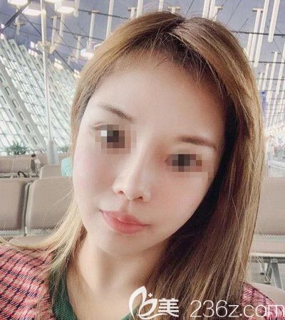 对比了几家医院后我选择韩国迪美丽整形外科做了面部提升+吸脂去双下巴手术