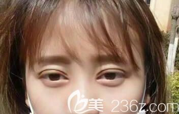 割双眼皮第7天拆线恢复还算不错