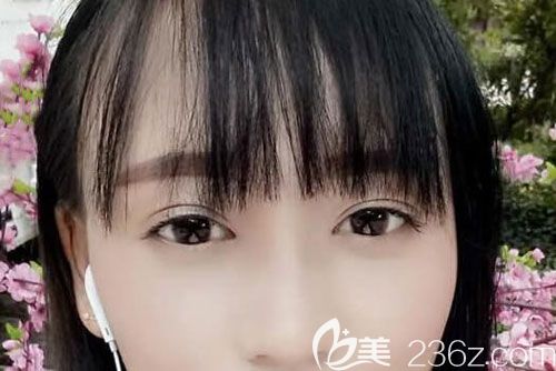 切开双眼皮已经20天没有肉条增生的现象