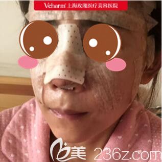 上海玫瑰医疗美容医院王晨光耳骨垫鼻尖+面部脂肪填充真人案例术后第3天