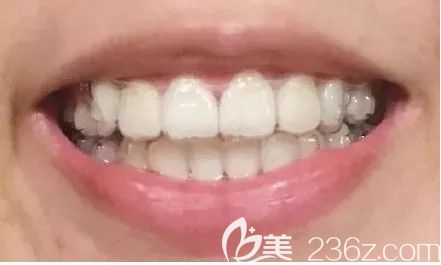 我参考过杭州牙科医院排名后才去维恩口腔做了时代天使单模矫正,面诊时还看到了杭州口腔医院价目表