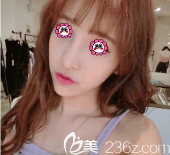 我在北京新星靓做玻尿酸填充苹果肌前样子 我在北京新星靓做玻尿酸填充苹果肌前样子