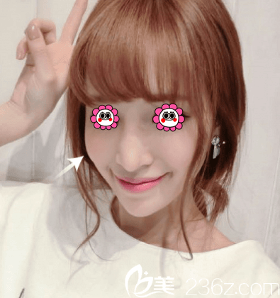 北京新星靓李伟民玻尿酸填充苹果肌案例 北京新星靓李伟民玻尿酸填充苹果肌案例