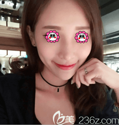 我在北京新星靓做玻尿酸填充苹果肌后不仅没移位而且脸型圆润也甜美