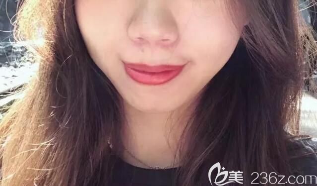 嘴凸龅牙矫正前正面的样子 嘴凸龅牙矫正前正面的样子