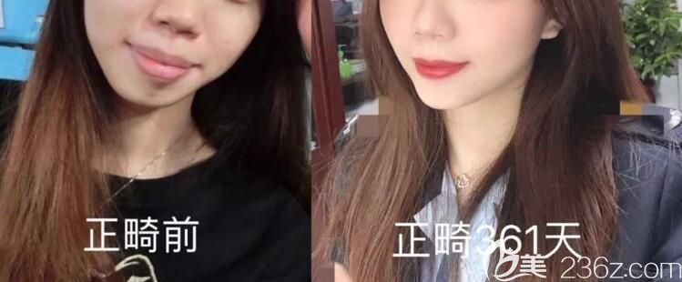 牙齿矫正361天前后对比照 牙齿矫正361天前后对比照