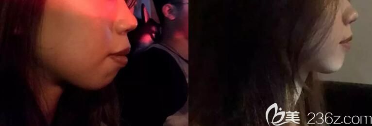 ▼龅牙矫正365天侧脸前后变化对比图 ▼龅牙矫正365天侧脸前后变化对比图