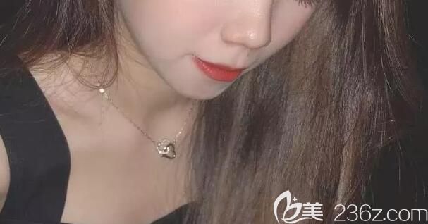 雅悦口腔矫正龅牙1年脸型图 雅悦口腔矫正龅牙1年脸型图